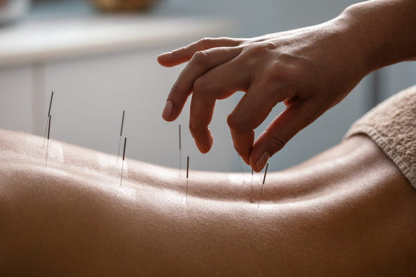 Holistic Pain Management: Acupuncture, Cupping, Nutrition & Lifestyle Tips