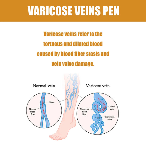 LED Therapy Pen For Varicose Veins Effective Relief Of Dilated Vasculitis In The Leg Phlebitis Health Improved Blood Circulation