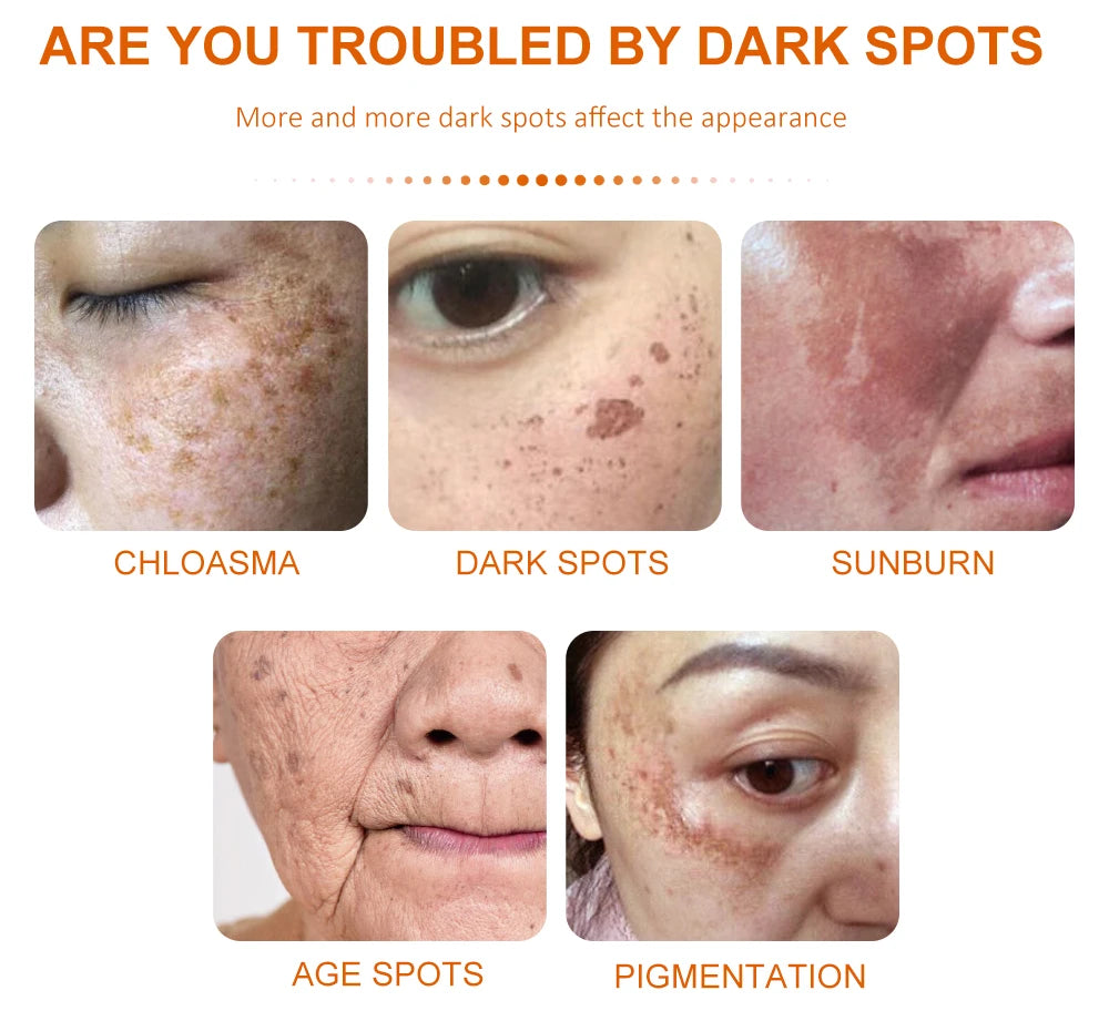 Dark Spot Remover Vitamin C Whitening Remove Melasma Freckle Sun Spots Anti-Pigmentation Improve Dullness Brighten Skin Care